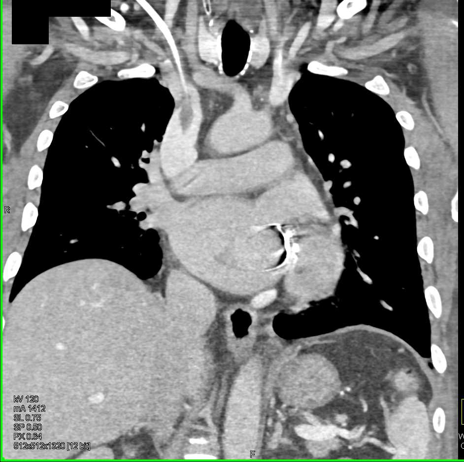 Multiple Clots Including Superior Vena Cava (SVC), Left Atrium and Right Femoral Vein - CTisus CT Scan