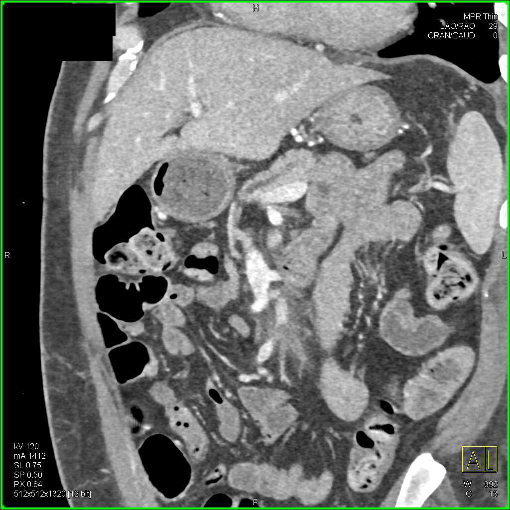 Multiple Clots Including Superior Vena Cava (SVC), and Left Atrium - CTisus CT Scan