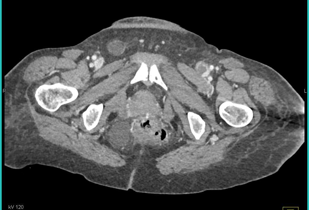 Left Femoral Deep Vein Thrombosis (DVT) - CTisus CT Scan