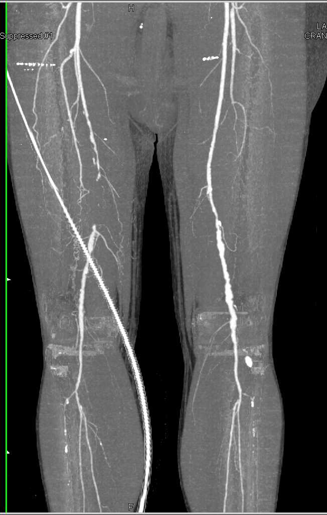 Superficial Femoral Artery (SFA) Occlusion with Severe Peripheral