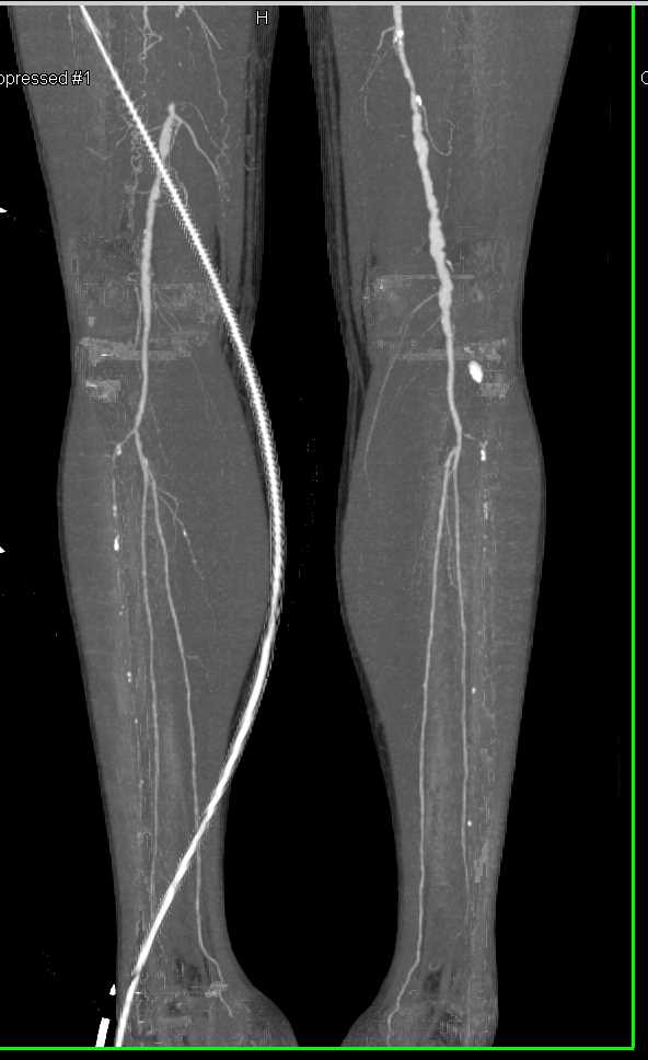 Superficial Femoral Artery (SFA) Occlusion with Severe Peripheral