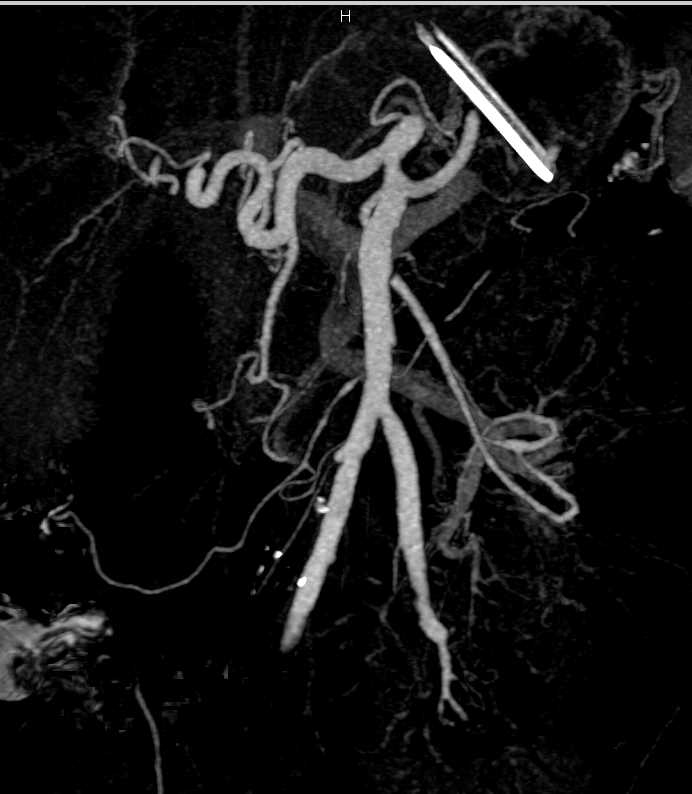 Vasculitis Involves the SMA - CTisus CT Scan