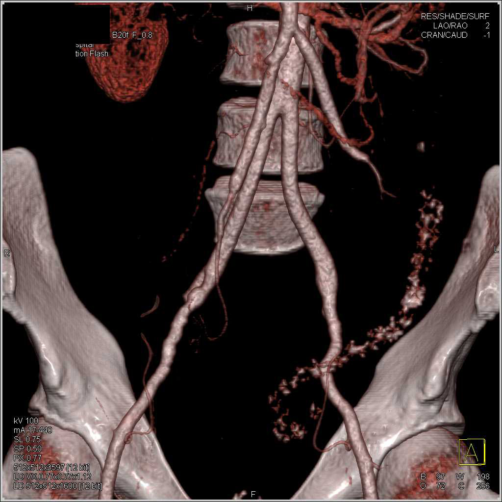 Vasculitis of the Mesenteric Vessels - CTisus CT Scan