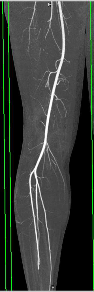 Stab Wound Calf Without Vascular Injury with Bone Removal - CTisus CT Scan