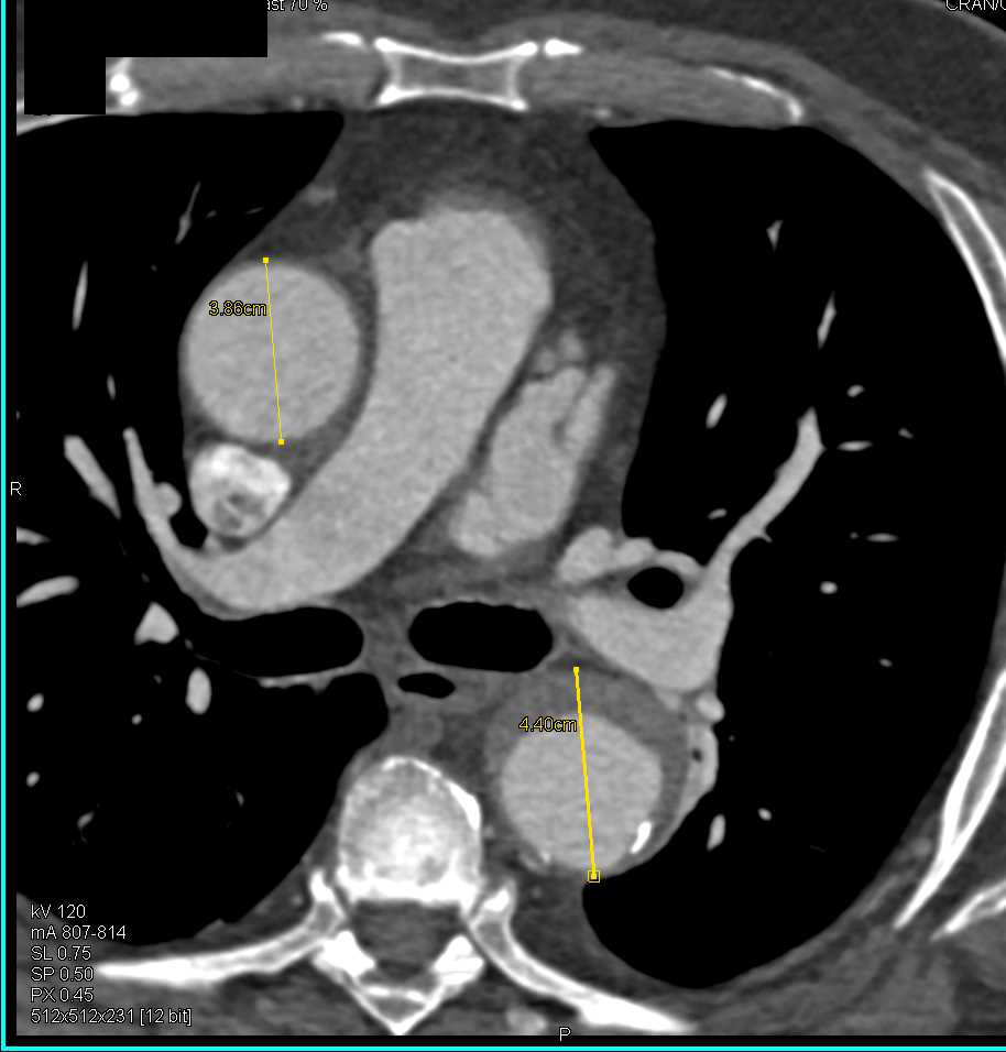 Ulceration with Intramural Hematoma Descending Aorta - CTisus CT Scan