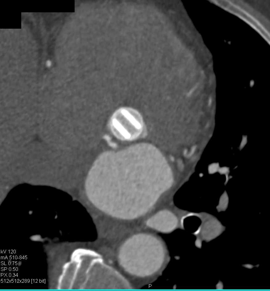 Aortic Valve Repair and Dilated Ascending Aorta - CTisus CT Scan