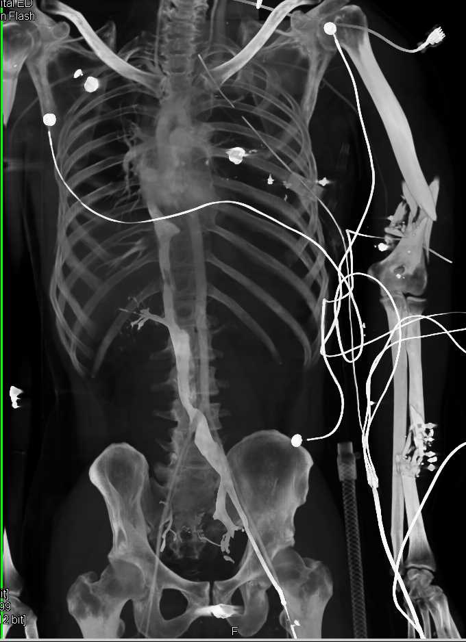 Arteriovenous (AV) Shunting with Early Inferior Vena Cava (IVC) Visualization - CTisus CT Scan