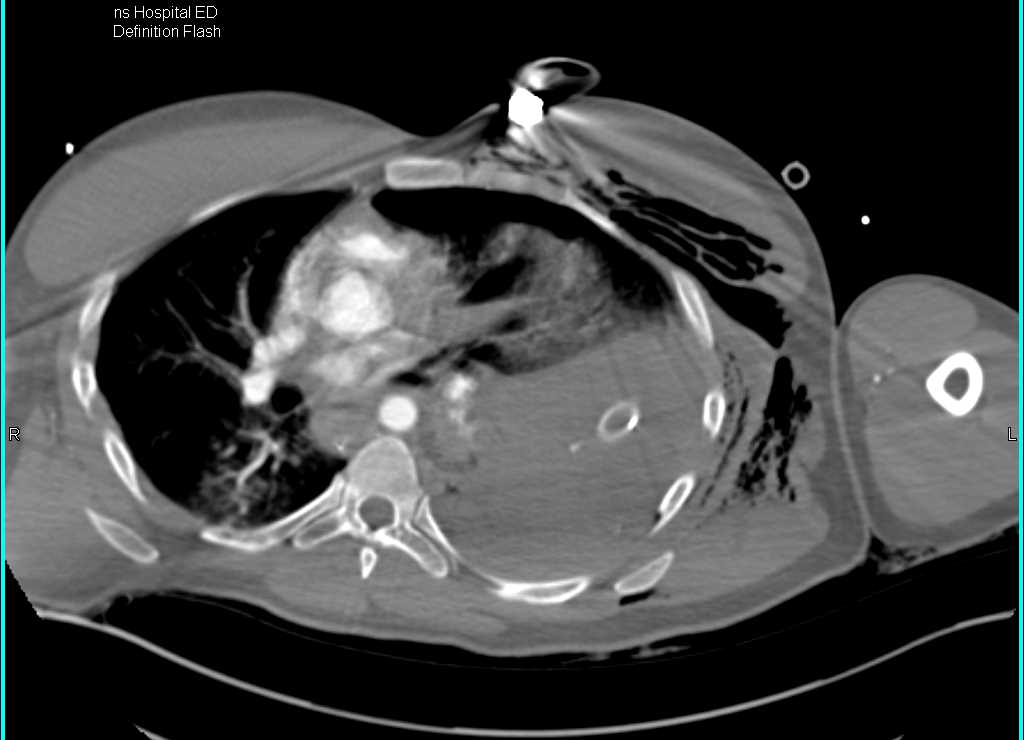 Arteriovenous (AV) Shunting with Early Inferior Vena Cava (IVC) Visualization due to GSW - CTisus CT Scan