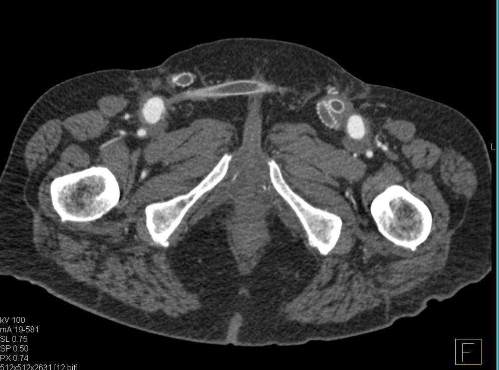 Occluded Fem-Fem Bypass Grafts - CTisus CT Scan