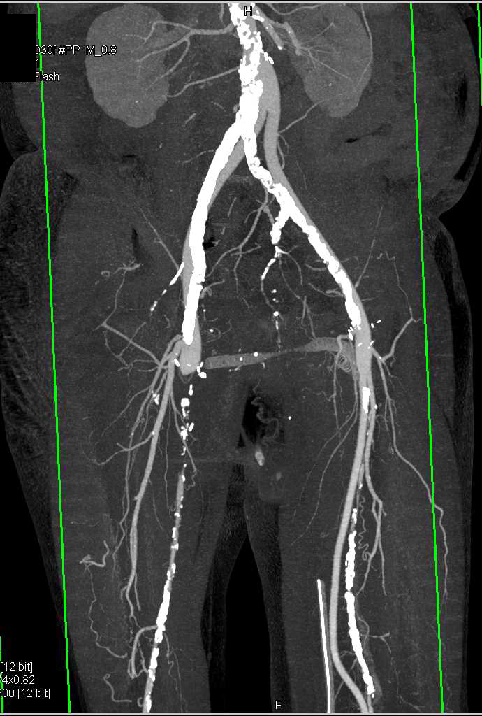 Occluded Fem-Fem Bypass Grafts - CTisus CT Scan