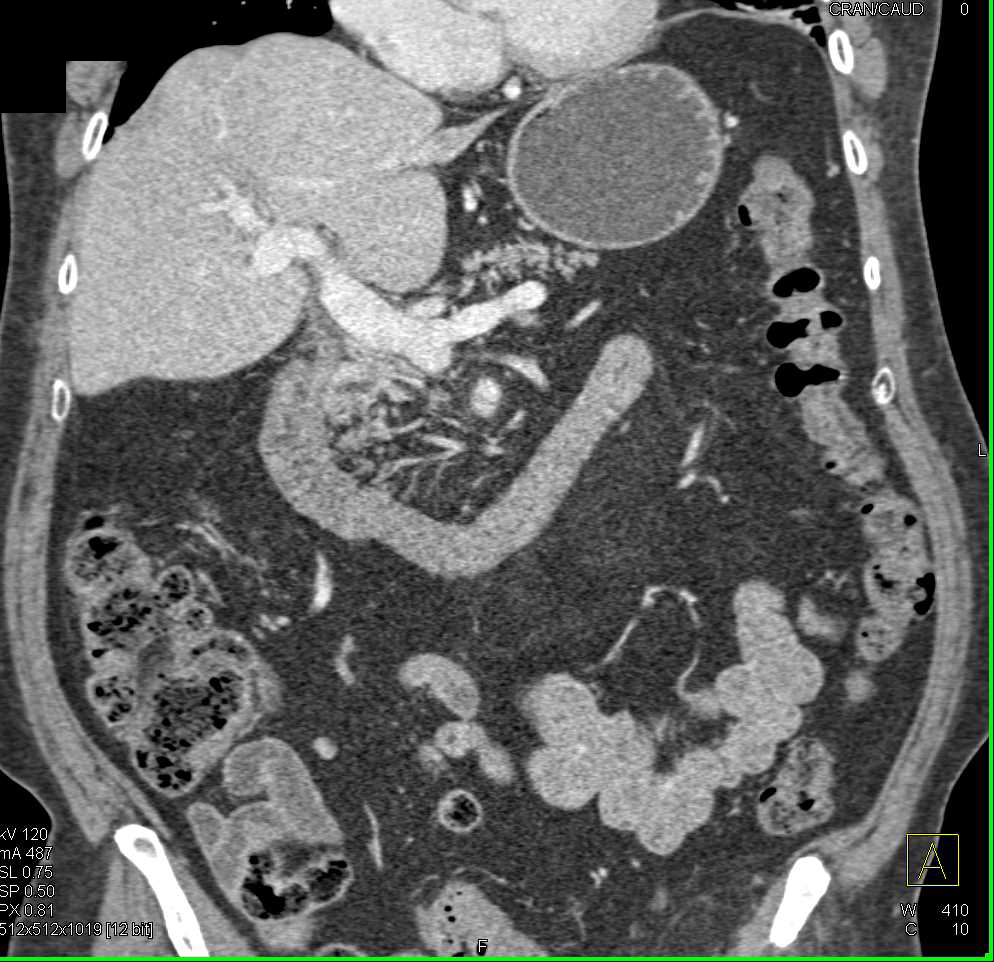 Focal Dissection of the Celiac Artery - CTisus CT Scan