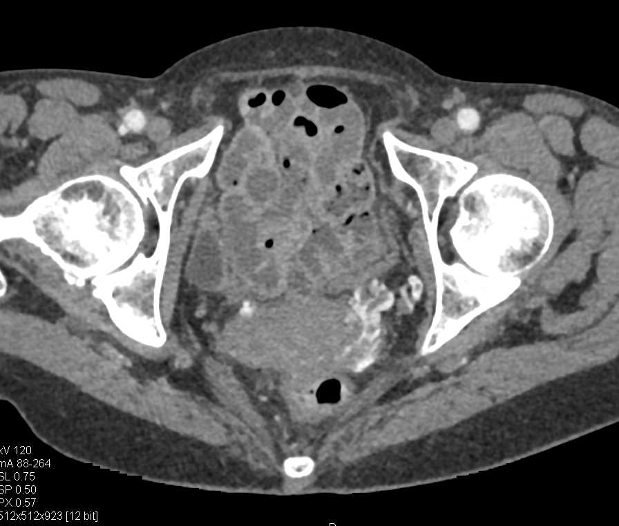 Large Pelvic Varices with Thrombi - CTisus CT Scan