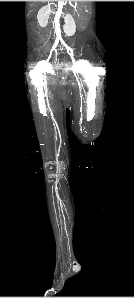 Femoral-Popliteal Bypass Grafts - CTisus CT Scan