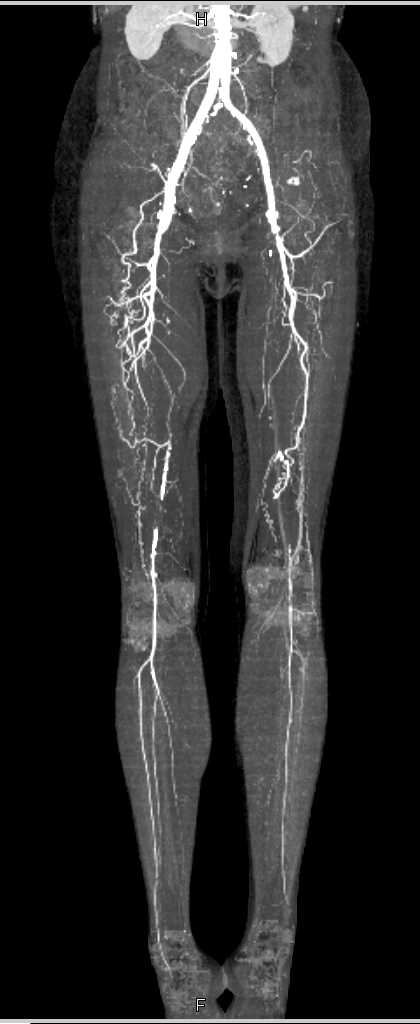 Occlusion of the Superficial Femoral Artery (SFA)'s Bilaterally with Collaterals - CTisus CT Scan