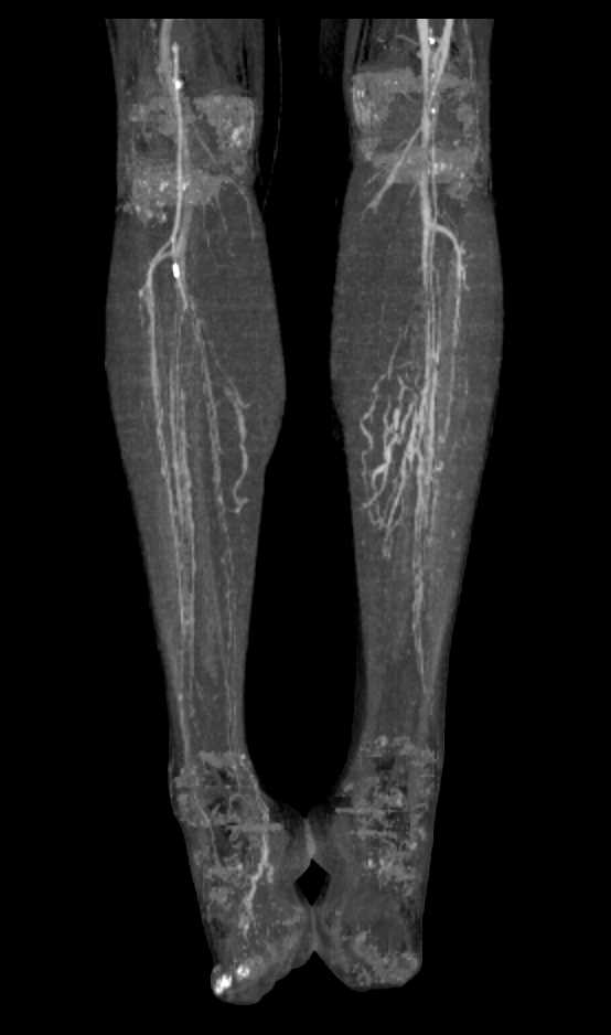 Occlusion of the Superficial Femoral Artery (SFA)'s Bilaterally with Collaterals - CTisus CT Scan