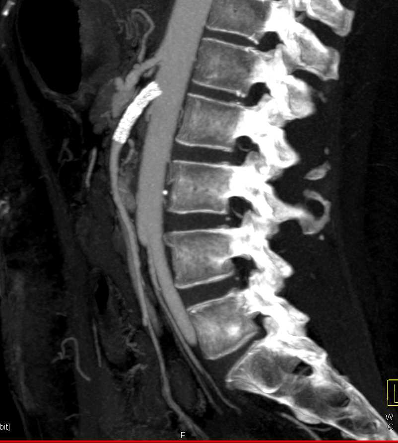 Patent Superior Mesenteric Artery (SMA) Stent with Left Renal Infarct - CTisus CT Scan