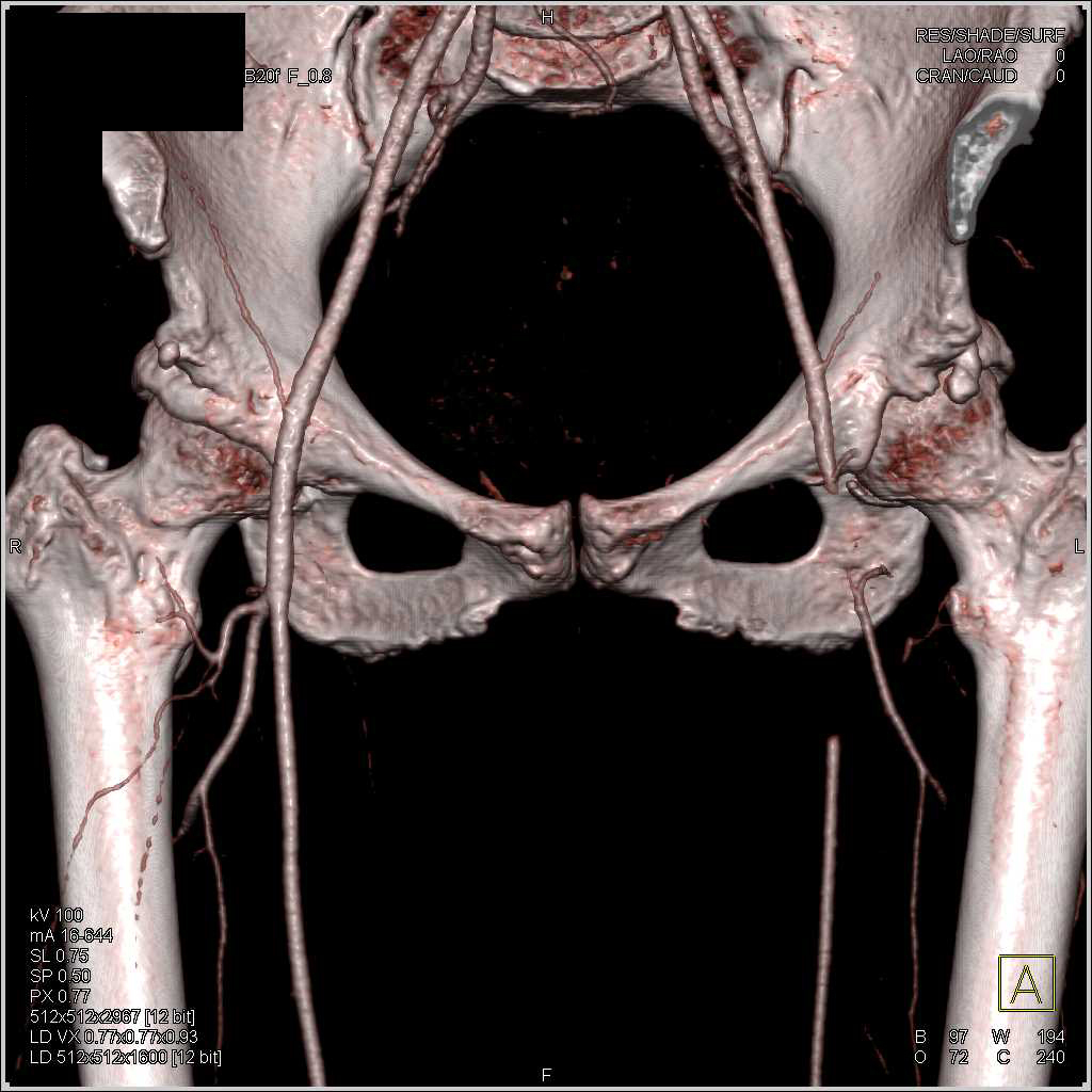 Acute Occlusion Left Femoral Artery and Right Renal Infarcts - CTisus CT Scan