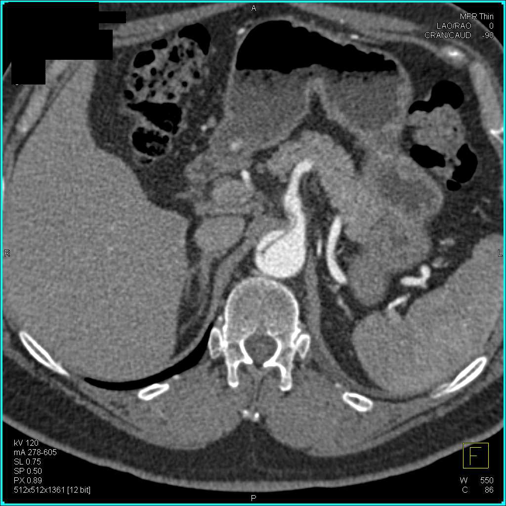 Aortic Dissection Involves the Superior Mesenteric Artery (SMA) and Celiac Arteries - CTisus CT Scan