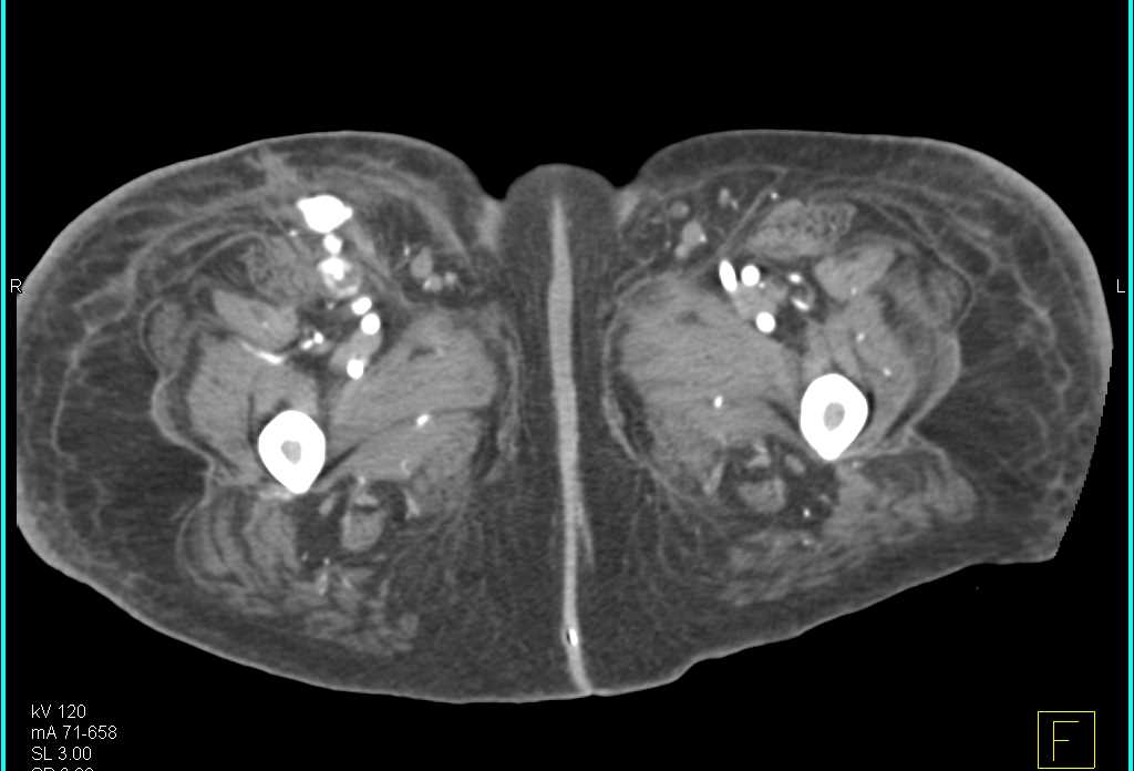 Pseudoaneurysm Groin with Incidental Appendicitis - CTisus CT Scan