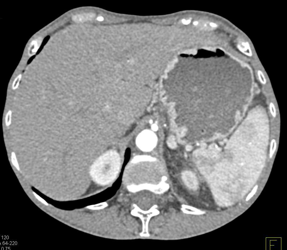 Pancreatic Cancer Invades Splenic Artery and Vein - CTisus CT Scan