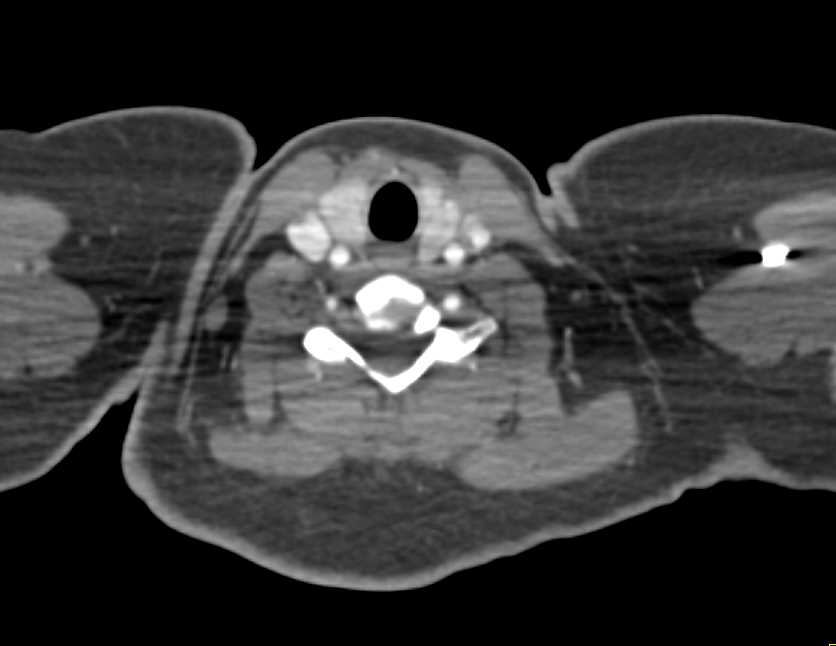 Normal Arch vessels - CTisus CT Scan