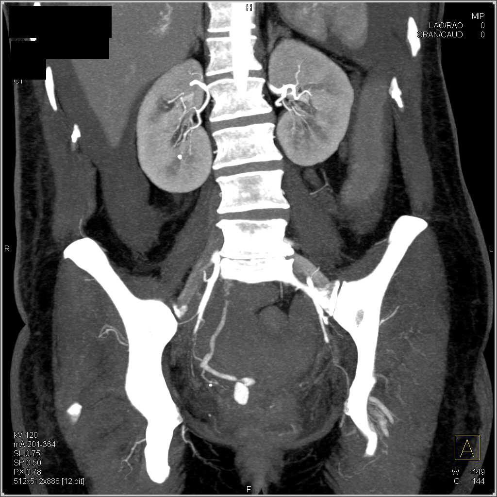Arteriovenous (AV) Fistulae with Active Bleed in the Pelvis - CTisus CT Scan
