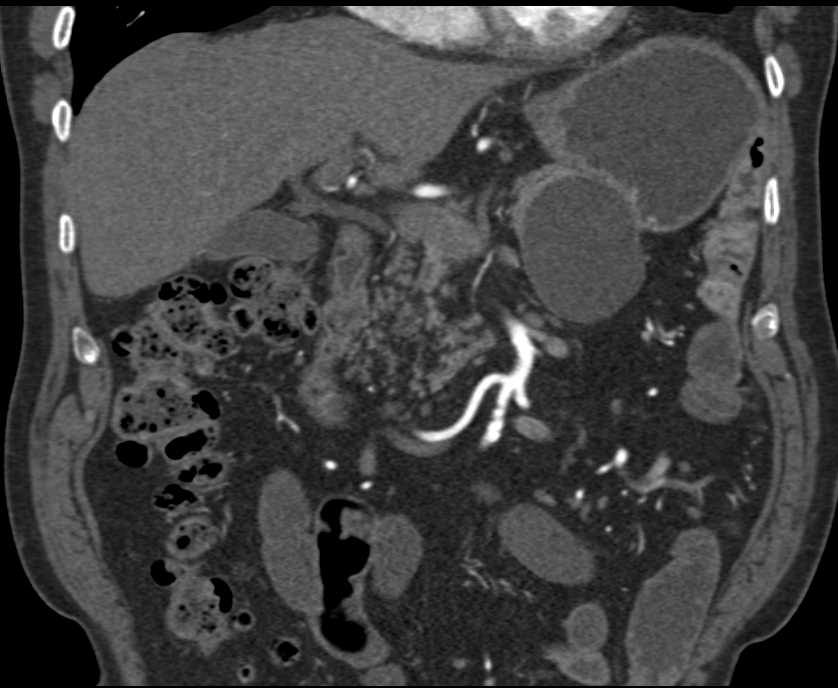 Vasculitis Involving the SMA - CTisus CT Scan