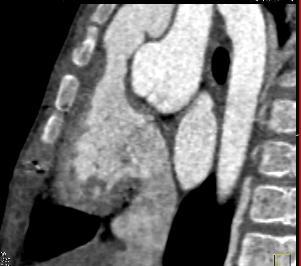 Dilated Aortic Root in Marfan Syndrome - CTisus CT Scan