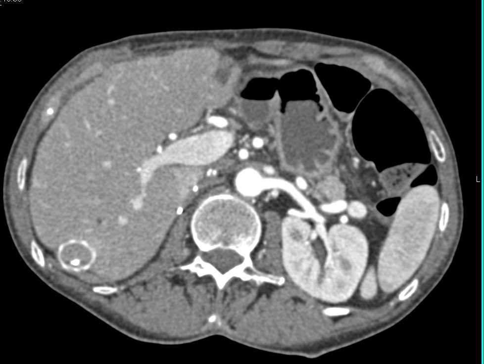 Vascular Shunt to Bypass Tumor Infiltration into the Inferior Vena Cava (IVC) - CTisus CT Scan