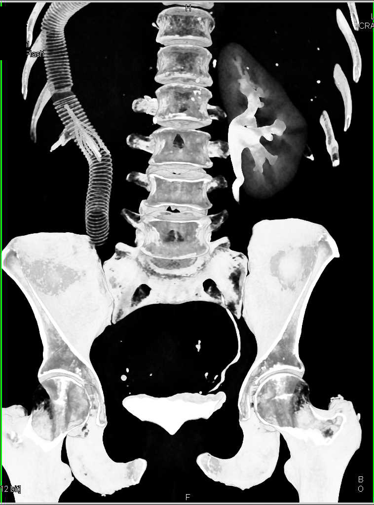 Vascular Shunt to Bypass Tumor Infiltration into the Inferior Vena Cava (IVC) - CTisus CT Scan