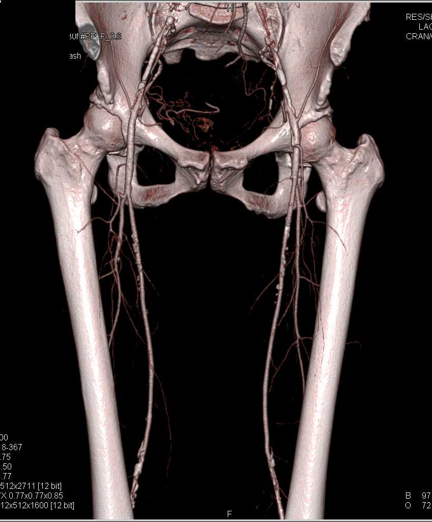 Occluded Abdominal Aorta with Collaterals - CTisus CT Scan