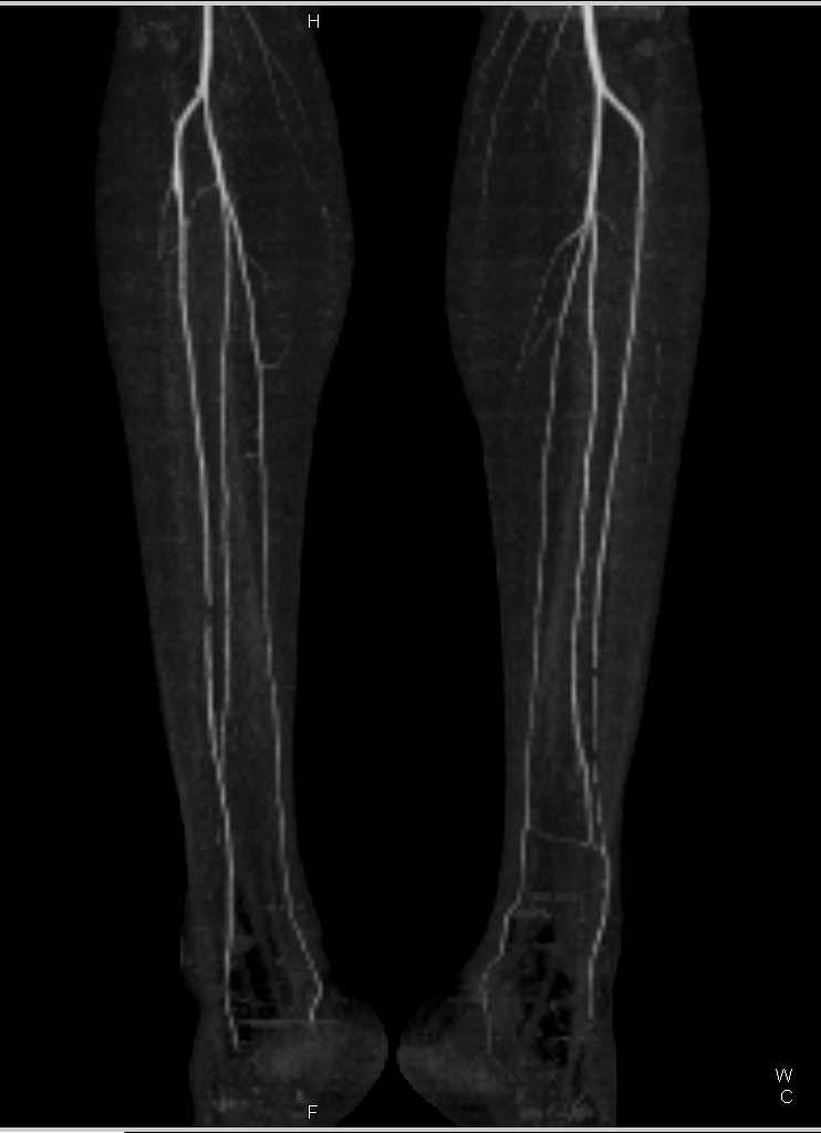 Occluded Abdominal Aorta with Collaterals - CTisus CT Scan