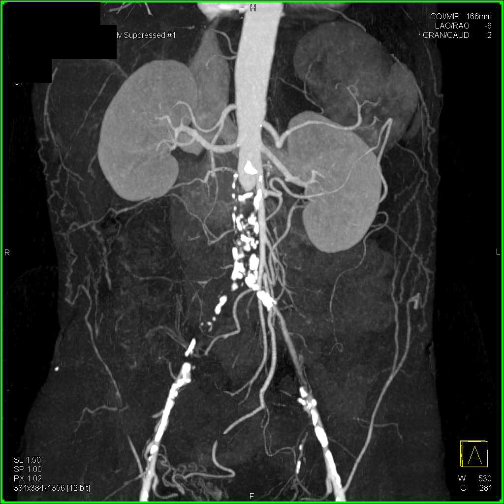 Occluded Abdominal Aorta with Collaterals - CTisus CT Scan