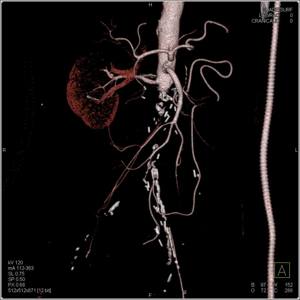 Aortic Occlusion with Axillary Shunt to Lower Extremity Anastomosis - CTisus CT Scan