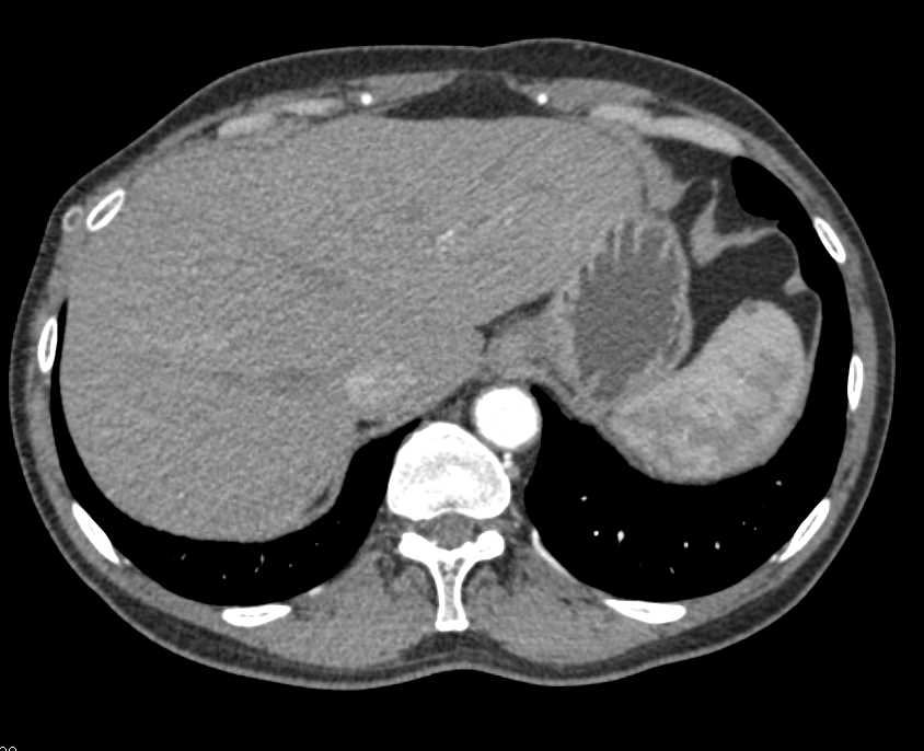 Multiple Occluded Vascular Stents - CTisus CT Scan