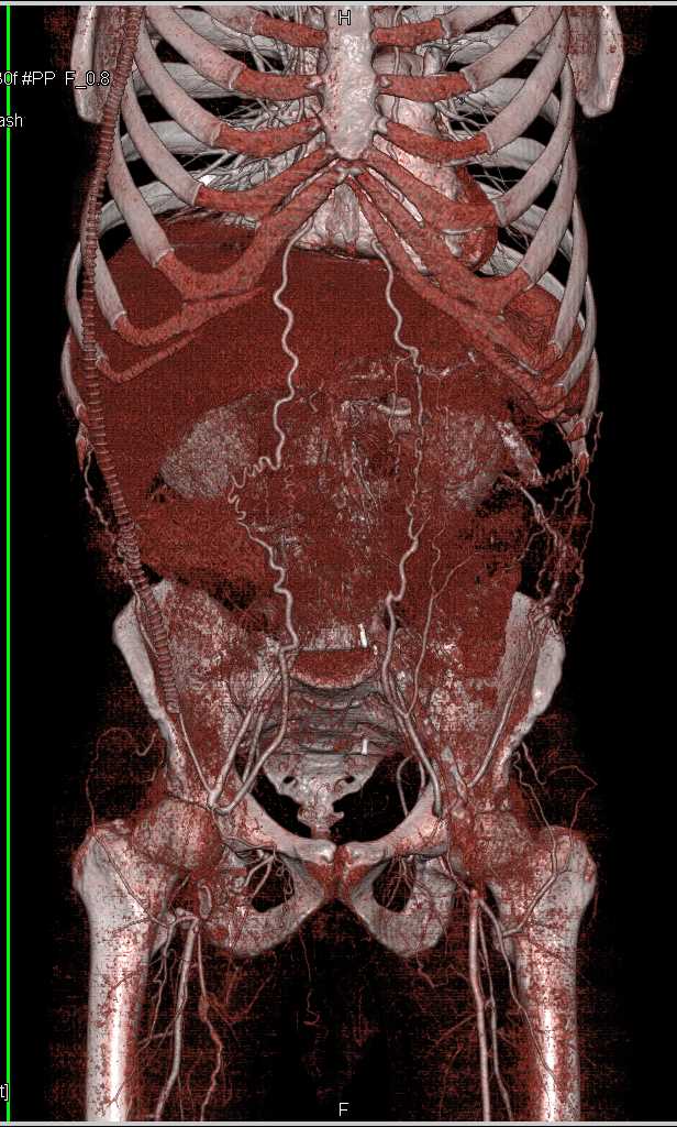 CTA Runoff with Right Superficial Femoral Artery (SFA) Occlusion - CTisus CT Scan