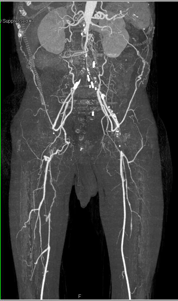 Bilateral Superficial Femoral Artery (SFA) and Iliac Artery Occlusion