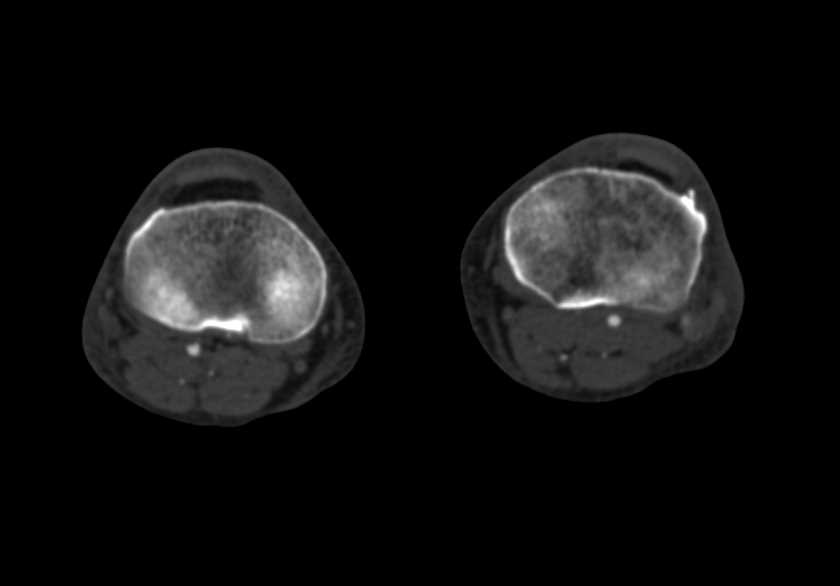 CTA with Fem-Fem Bypass Graft and Occluded Left Common Iliac Artery - CTisus CT Scan