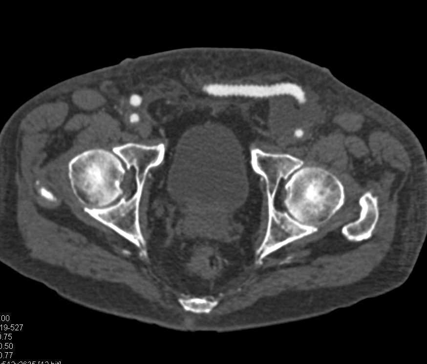 CTA with Fem-Fem Bypass Graft and Occluded Left Common Iliac Artery and Stenosis of Celiac Artery - CTisus CT Scan