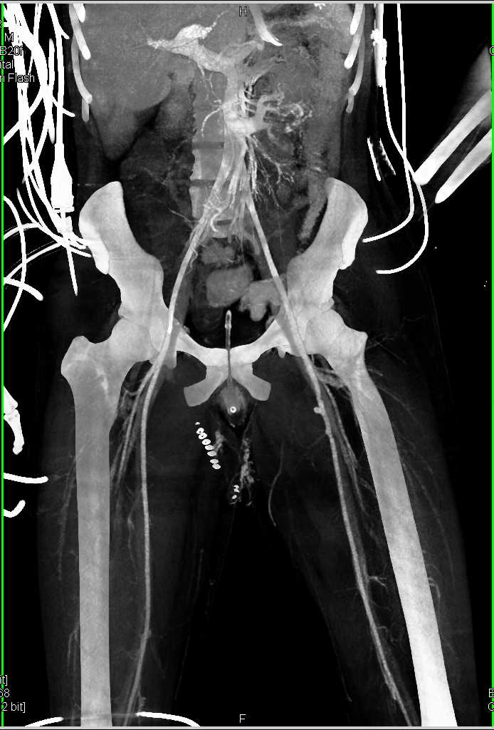 GSW With Decreased Vascular Flow and Small Distal Arterial Map - CTisus CT Scan