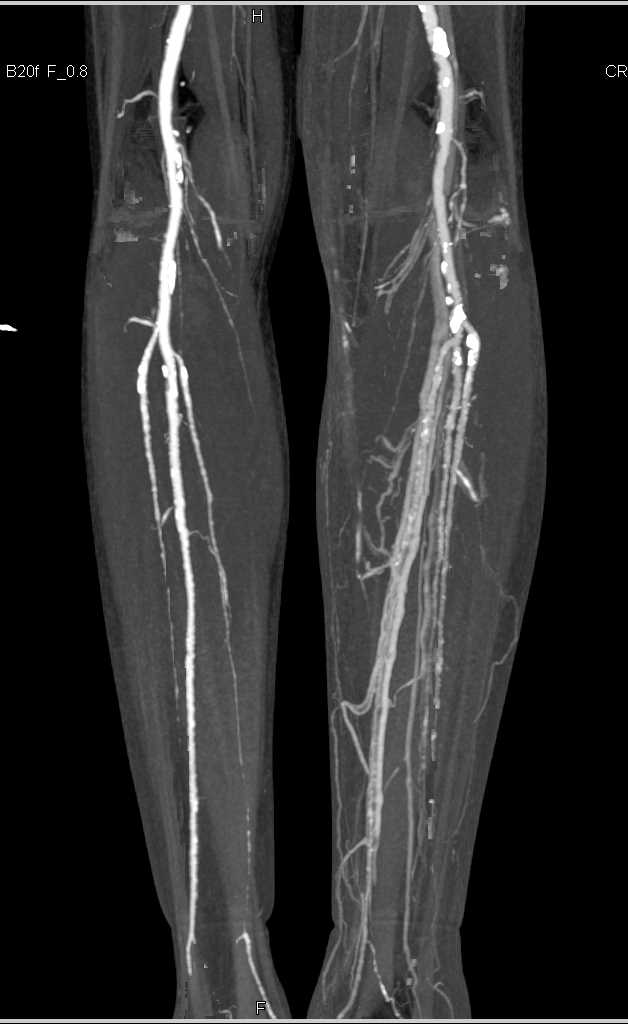 CTA Runoff with Early Venous Filling on the Left Side - CTisus CT Scan