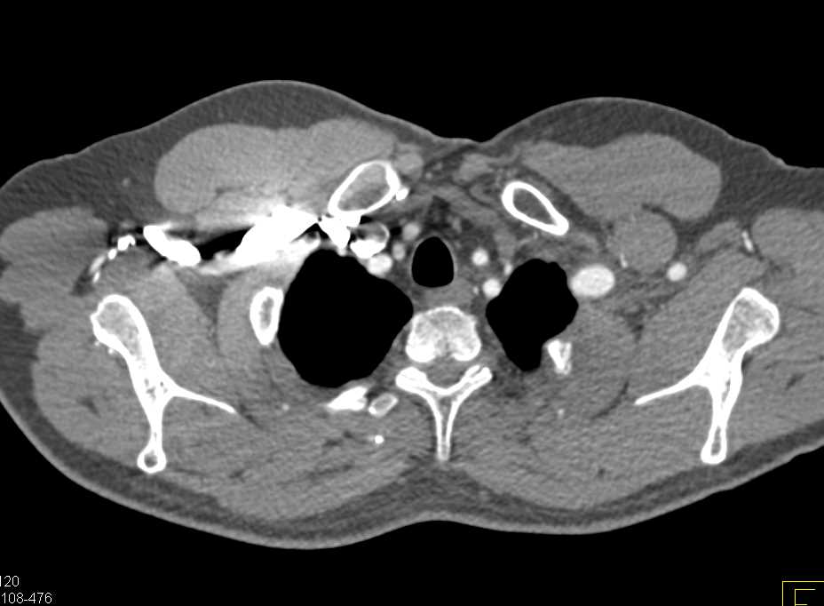 Ehlers-Danlos Syndrome with Multiple Dissections and Aneurysms - CTisus CT Scan