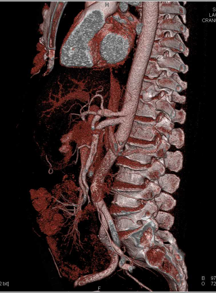 Ehlers-Danlos Syndrome with Multiple Dissections and Aneurysms Including Left Subclavian Artery and Celiac Artery - CTisus CT Scan