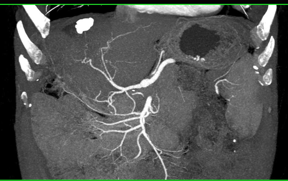 Cirrhosis with Large Varices Including Dilated Gonadal Veins and Pelvic ...