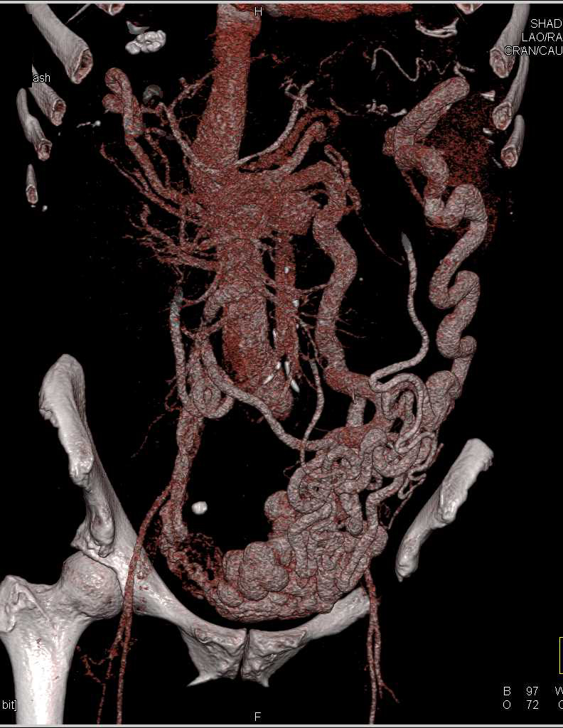 Cirrhosis with Large Varices Including Dilated Gonadal Veins and Pelvic Veins - CTisus CT Scan