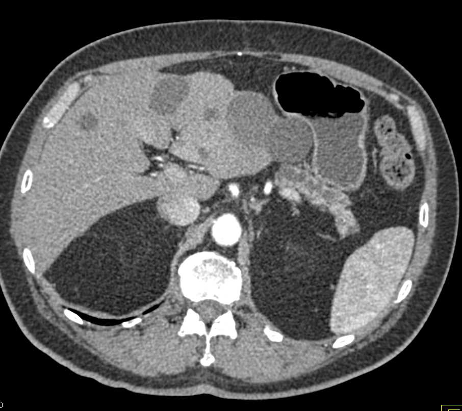 Pseudoaneurysm of Branch of the SMA - CTisus CT Scan