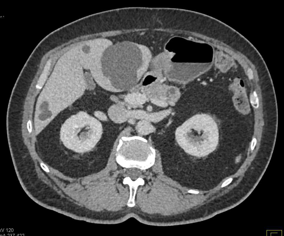 Pseudoaneurysm of Branch of the SMA - CTisus CT Scan