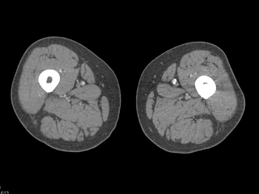 CTA Runoff with PVD (Peripheral Vascular Disease) - CTisus CT Scan