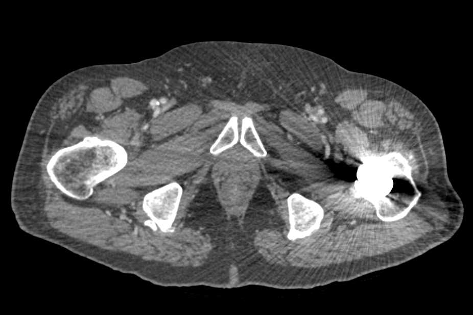 CTA Runoff with PVD (Peripheral Vascular Disease) - CTisus CT Scan