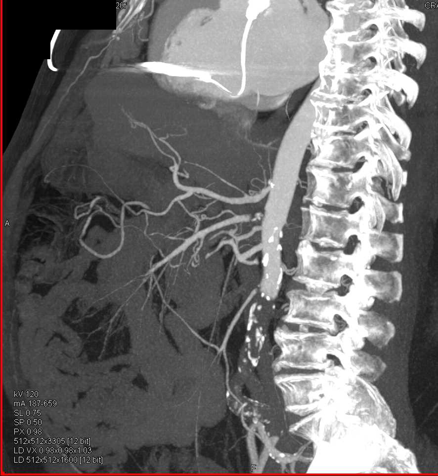 Multiple Clots in Left Atrium, Pulmonary Arteries and SMA - CTisus CT Scan